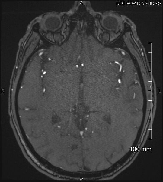File:Anterior cerebral artery aneurysm (Radiopaedia 80683-94127 Axial MRA 116).jpg
