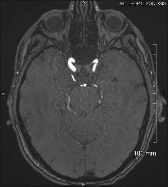 File:Anterior cerebral artery aneurysm (Radiopaedia 80683-94127 Axial MRA 85).jpg