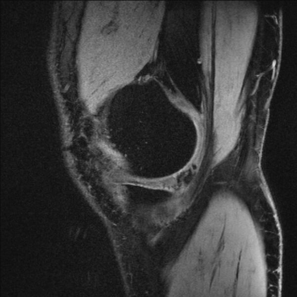 File:Anterior cruciate ligament mucoid degeneration (Radiopaedia 68400-77933 Sagittal 57).jpg