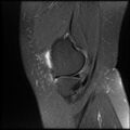 Anterior cruciate ligament tear, Wrisberg rip and bucket-handle tear of medial meniscus (Radiopaedia 75872-87266 Sagittal PD fat sat 22).jpg