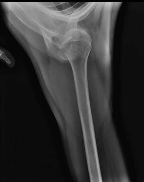 File:Anterior shoulder dislocation with fracture of greater tuberosity of humeral head (Radiopaedia 12197-12522 Axillary view 1).jpg