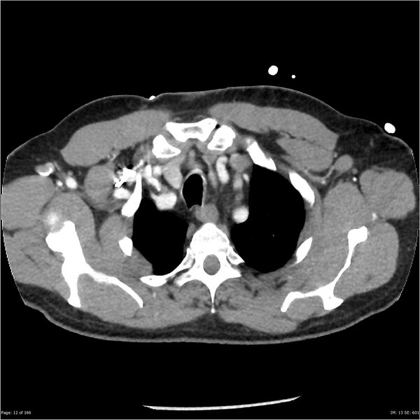 File:Aortic dissection- Stanford A (Radiopaedia 37759-39664 A 3).jpg