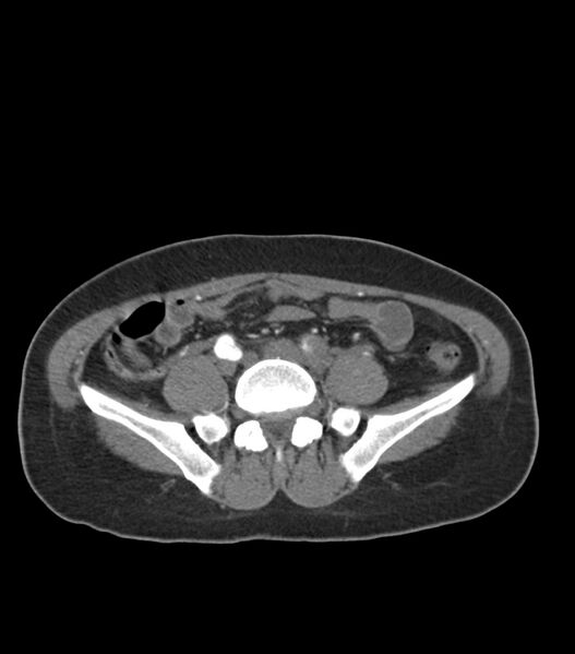 File:Aortic dissection with renal ischemia (Radiopaedia 76573-88338 A 90).jpg