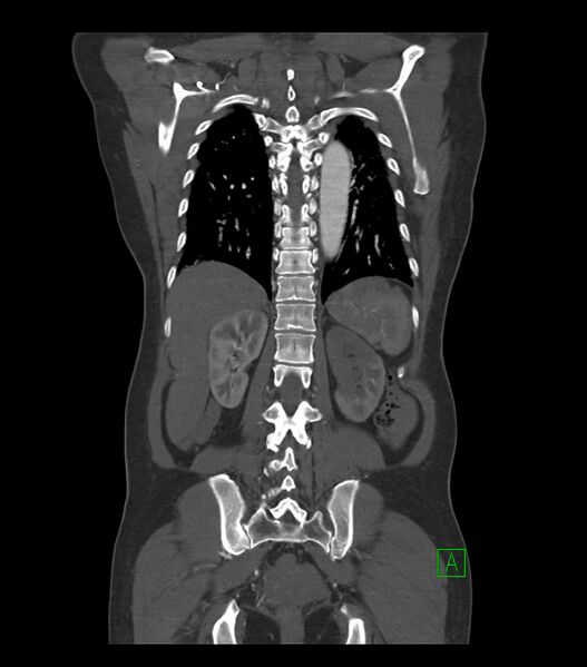 File:Aortic dissection with renal ischemia (Radiopaedia 76573-88338 C 29).jpg