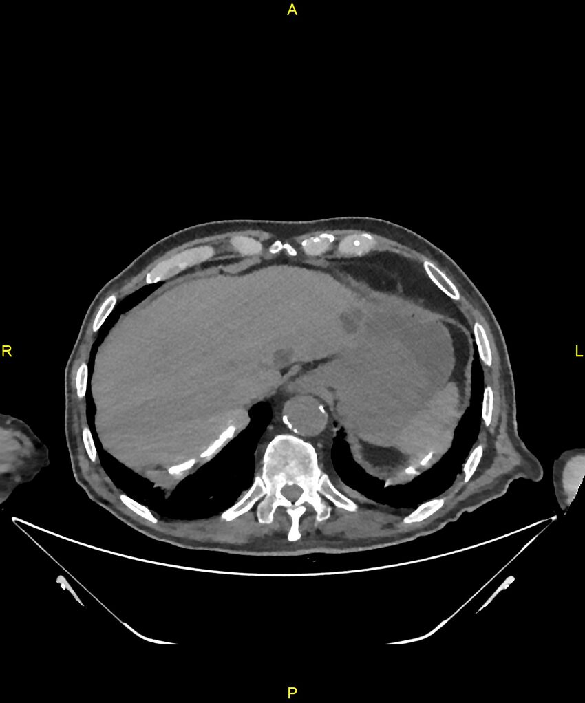 Aortoenteric fistula (Radiopaedia 84308-99603 Axial non-contrast 32).jpg