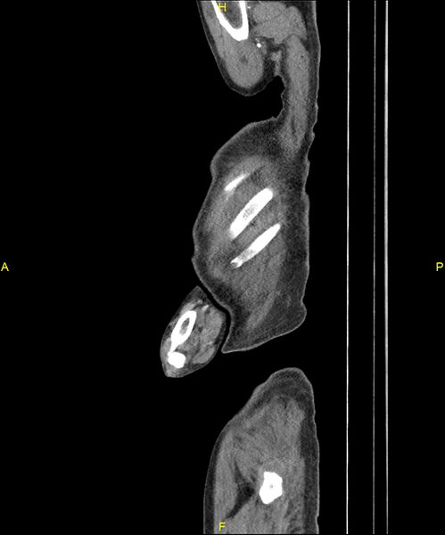 File:Aortoenteric fistula (Radiopaedia 84308-99603 C 14).jpg