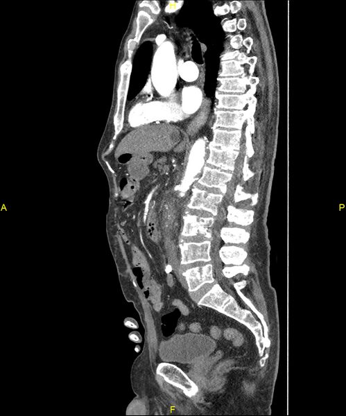 File:Aortoenteric fistula (Radiopaedia 84308-99603 C 172).jpg