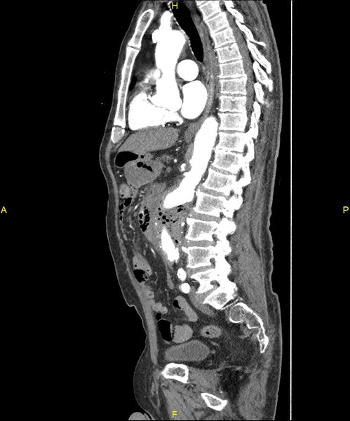 File:Aortoenteric fistula (Radiopaedia 84308-99603 C 189).jpg