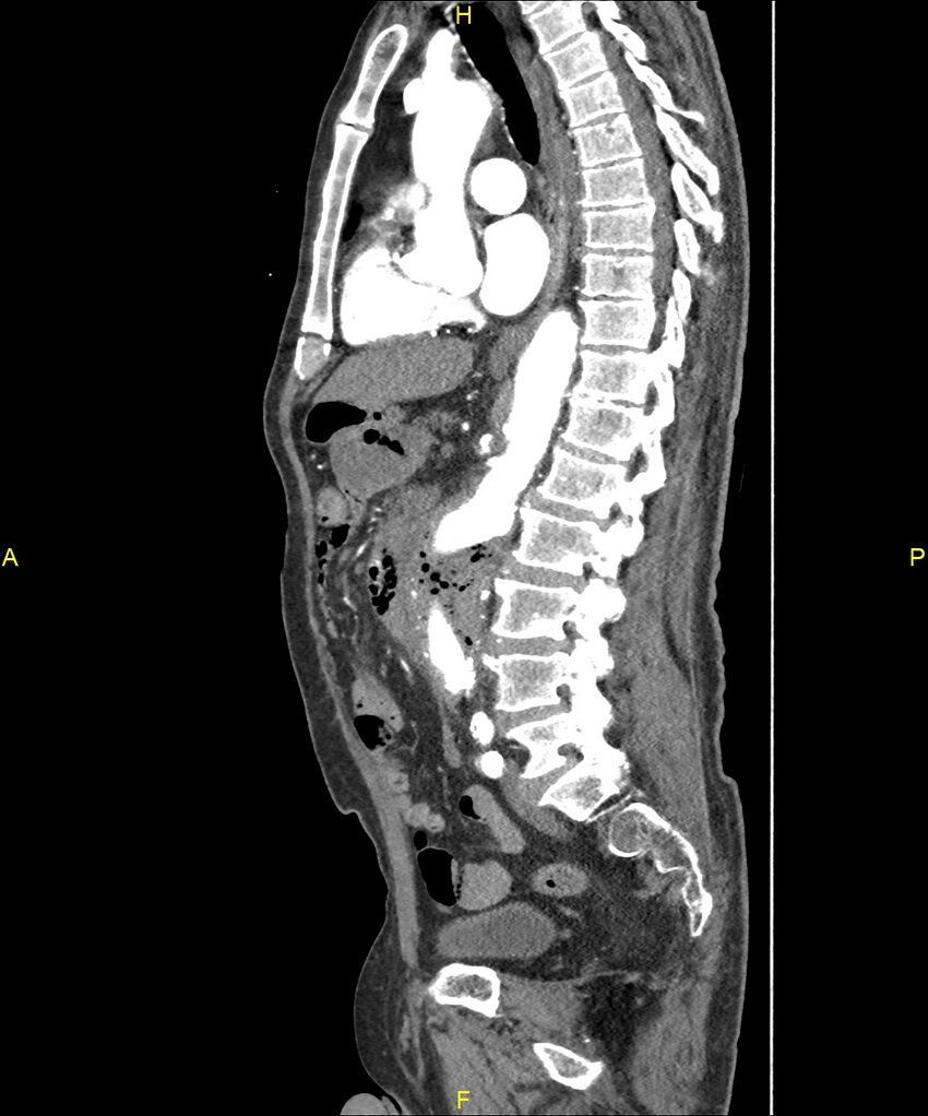 Aortoenteric fistula (Radiopaedia 84308-99603 C 189).jpg