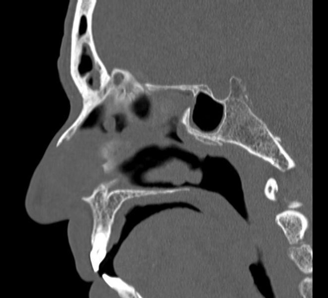File:Aplastic maxillary sinuses (Radiopaedia 60030-67561 Sagittal bone window 16).jpg
