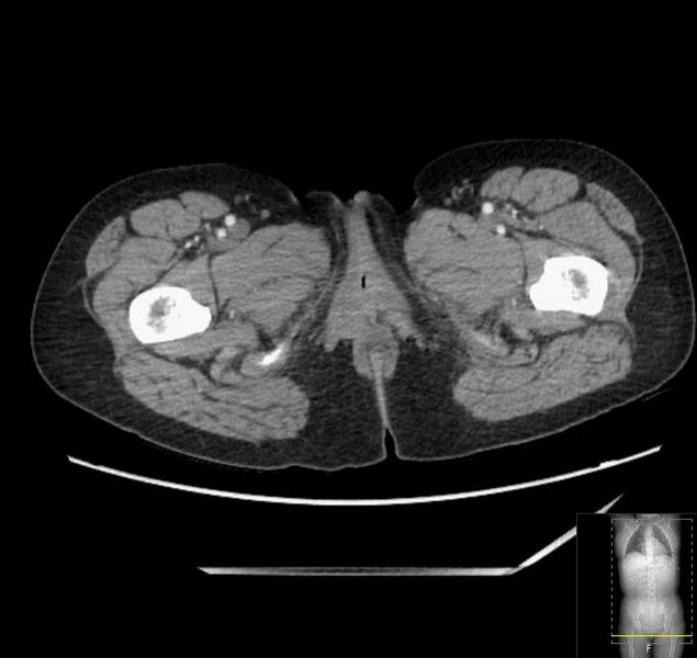 File:Appendicitis (CT angiogram) (Radiopaedia 154713-127660 Axial 114).jpg