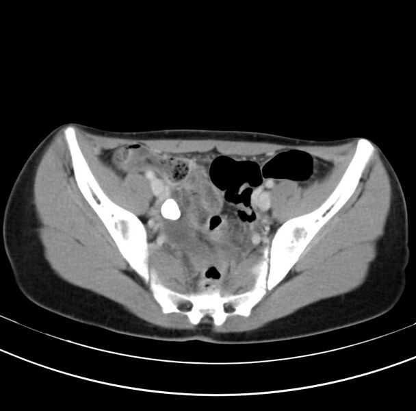 File:Appendicitis and incidental bicornuate uterus (Radiopaedia 22833-22853 B 37).jpg