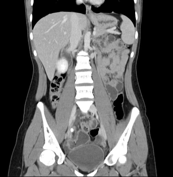 File:Appendicitis and incidental bicornuate uterus (Radiopaedia 22833-22853 D 21).jpg