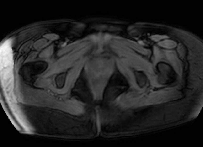 Appendicitis in gravida (MRI) (Radiopaedia 89433-106395 Axial DIXON 153).jpg