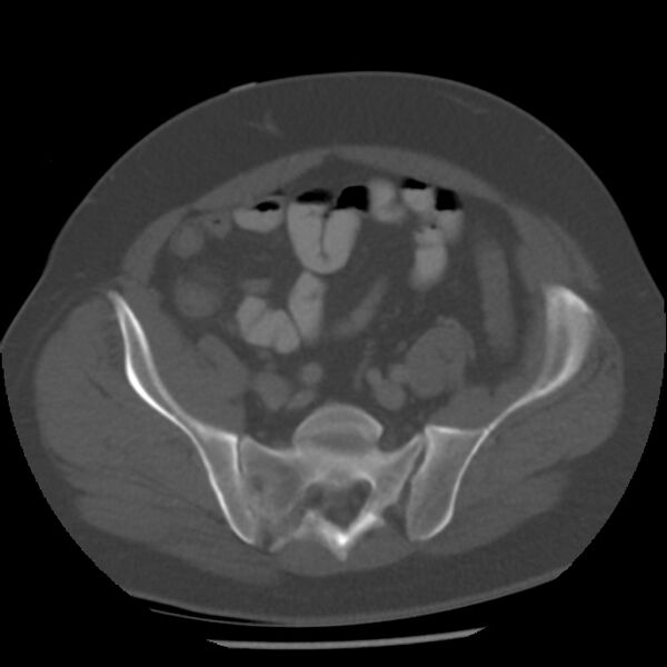 File:Appendicitis with perforation (Radiopaedia 35790-37342 Axial bone window 40).jpg