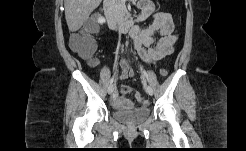 Appendix mucocele (Radiopaedia 41222-44033 B 42).jpg