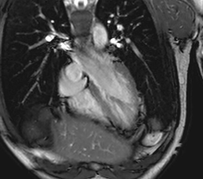 File:Arrhythmogenic right ventricular cardiomyopathy (Radiopaedia 39806-42237 D 128).jpg