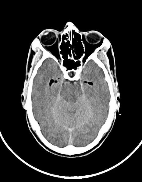 File:Arrow injury to the brain (Radiopaedia 72101-82607 Axial 31).jpg