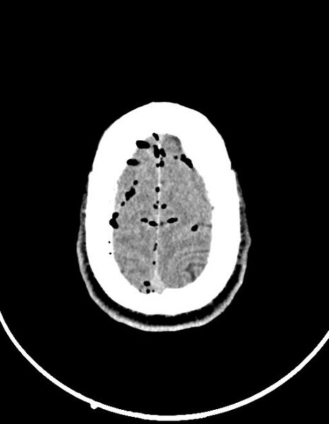 File:Arrow injury to the brain (Radiopaedia 72101-82607 Axial non-contrast 89).jpg