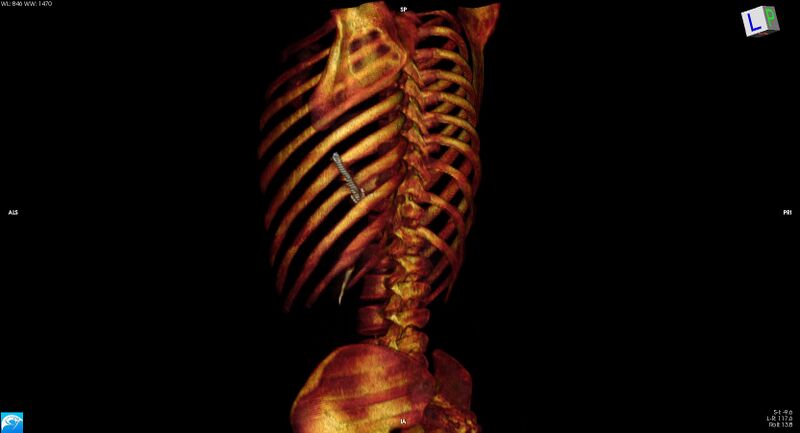 File:Arrow injury to the chest (Radiopaedia 75223-86321 3D bone 16).jpg