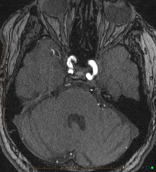 File:Artifactual basilar artery stenosis due to metallic stent (Radiopaedia 31206-31922 Axial MRA 9).jpg