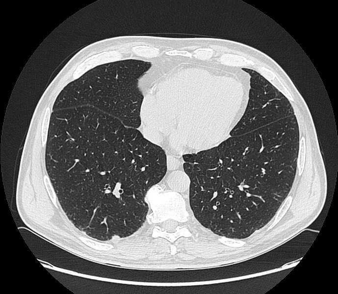 File:Asbestos pleural placques (Radiopaedia 57905-64872 Axial lung window 171).jpg