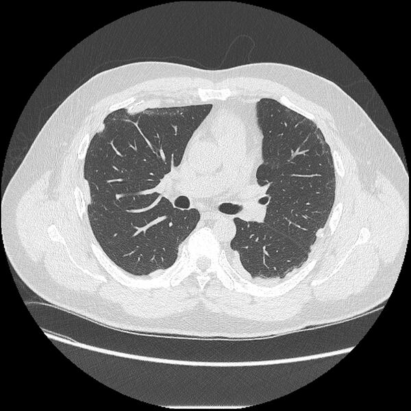 File:Asbestosis (Radiopaedia 45002-48961 Axial lung window 23).jpg