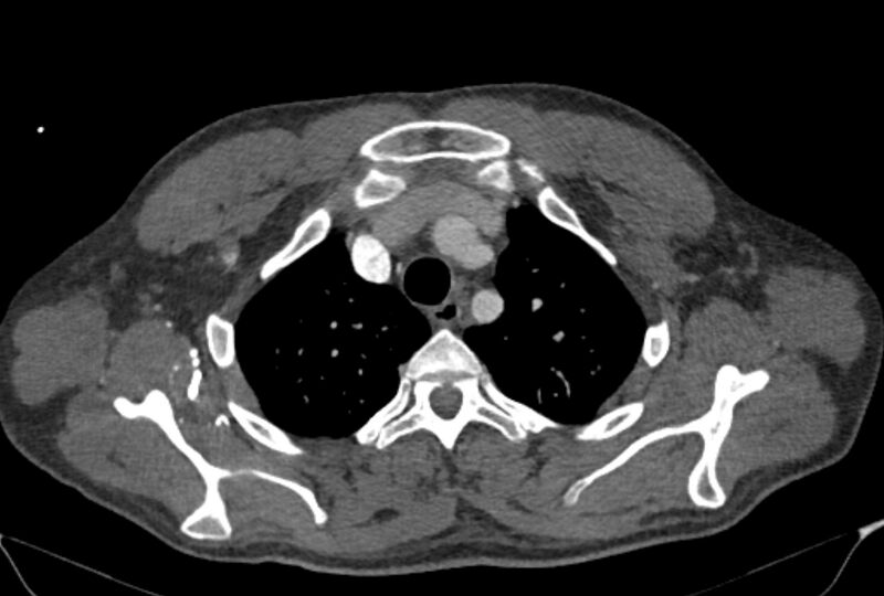 File:Ascending aortic aneurysm (Radiopaedia 86279-102297 C 9).jpg