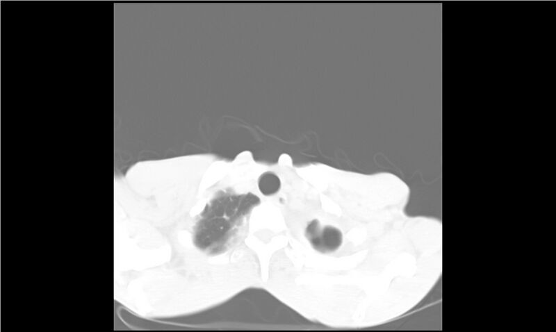 File:Aspergilloma (Radiopaedia 20788-20701 Axial lung window 3).jpg