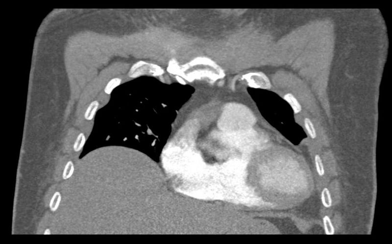 File:Aspirated tooth (Radiopaedia 28584-28844 Coronal C+ CTPA 21).jpg