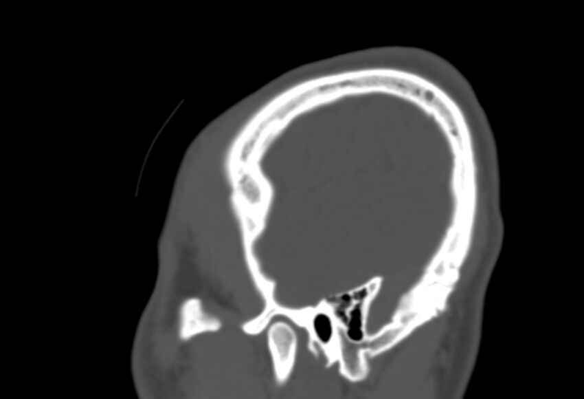 Asymptomatic occipital spur (Radiopaedia 87753-104201 Sagittal bone window 282).jpg