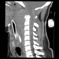 Atlanto-occipital dislocation (Radiopaedia 44648-48412 A 15).jpg
