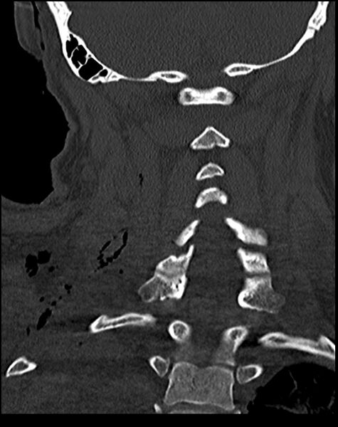 File:Atlanto-occipital dissociation - Traynelis type 1 (Radiopaedia 87570-103948 Coronal bone window 41).jpg