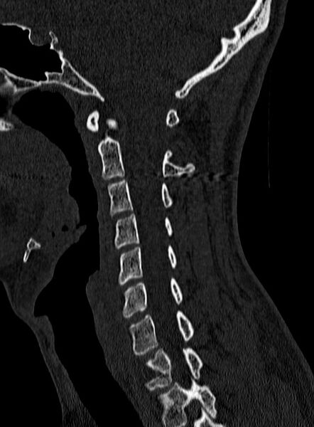 File:Atlantoaxial subluxation (Radiopaedia 44681-48450 Sagittal bone window 57).jpg