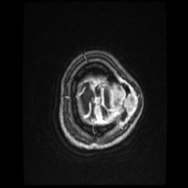 File:Atypical meningioma (Radiopaedia 45535-49629 Axial T1 C+ 61).jpg