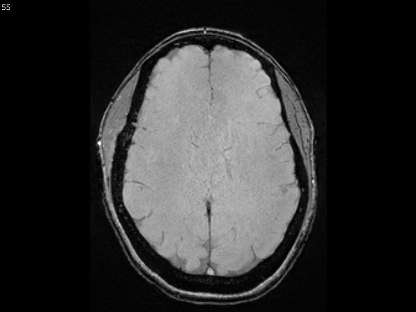 Atypical meningioma - intraosseous (Radiopaedia 64915-74572 Axial SWI 55).jpg