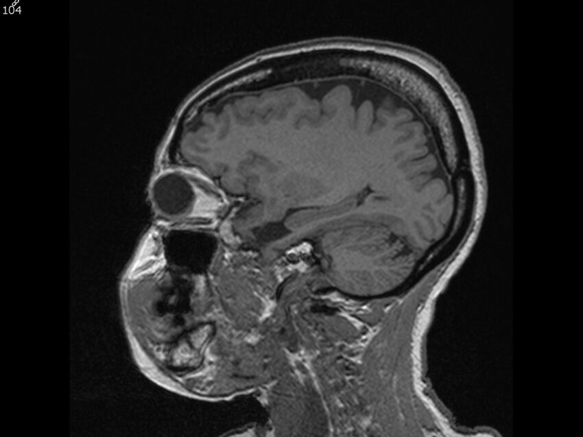 Atypical meningioma - intraosseous (Radiopaedia 64915-74572 Sagittal T1 104).jpg