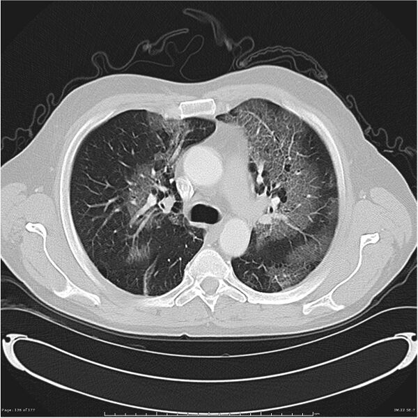 File:Atypical pneumonia - Q fever (Radiopaedia 21993-21989 lung window 15).jpg