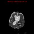 Atypical teratoid rhabdoid tumor (Radiopaedia 10712-11183 Axial ADC 7).jpg