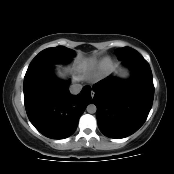 File:Autosomal dominant polycystic kidney disease (Radiopaedia 23061-23093 Axial non-contrast 3).jpg