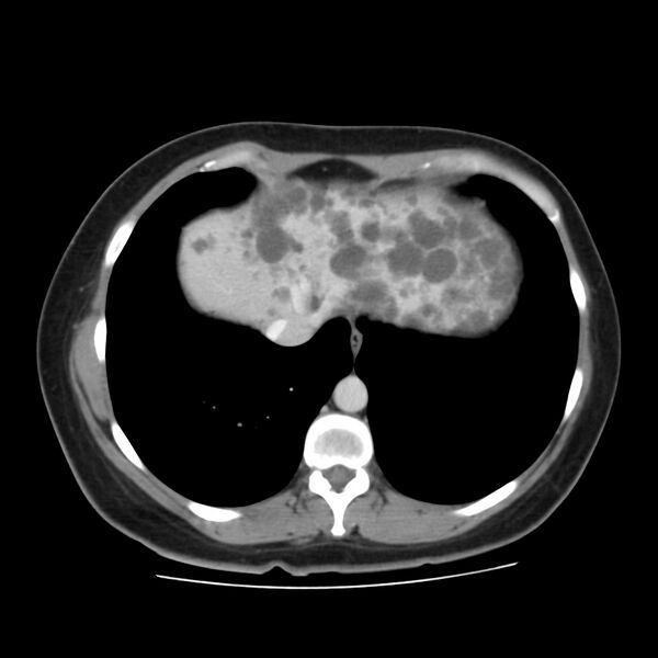 File:Autosomal dominant polycystic kidney disease (Radiopaedia 23061-23093 C 6).jpg