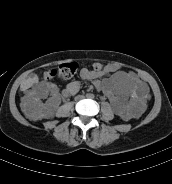 File:Autosomal dominant polycystic kidney disease (Radiopaedia 41918-44922 Axial non-contrast 19).jpg