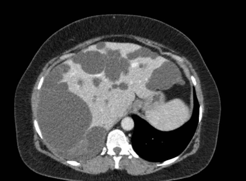 File:Autosomal dominant polycystic kidney disease (Radiopaedia 57124-64017 A 28).jpg