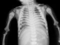 Autosomal recessive osteopetrosis (Radiopaedia 7417-8261 Frontal 1).jpg