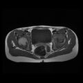 Avascular necrosis of the hip (Radiopaedia 29563-30067 Axial T1 5).jpg