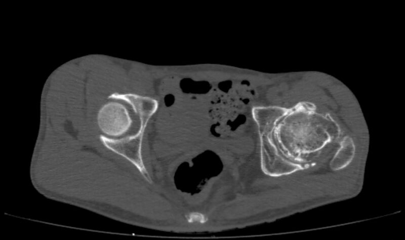 File:Avascular necrosis of the left hip (Radiopaedia 75068-86125 Axial bone window 43).jpg