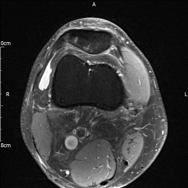 File:Avulsion fracture of the fibular head (Radiopaedia 74804-85808 Axial PD fat sat 6).jpg
