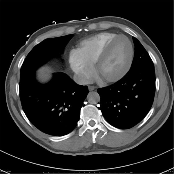 File:Azygos venous system anatomy (CT pulmonary angiography) (Radiopaedia 25928-26077 Axial C+ CTPA 66).jpg
