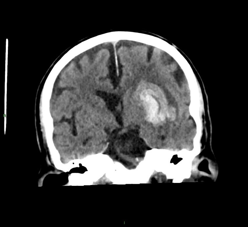 Basal ganglia hemorrhage (Radiopaedia 58791-66025 Coronal non-contrast 34).jpg
