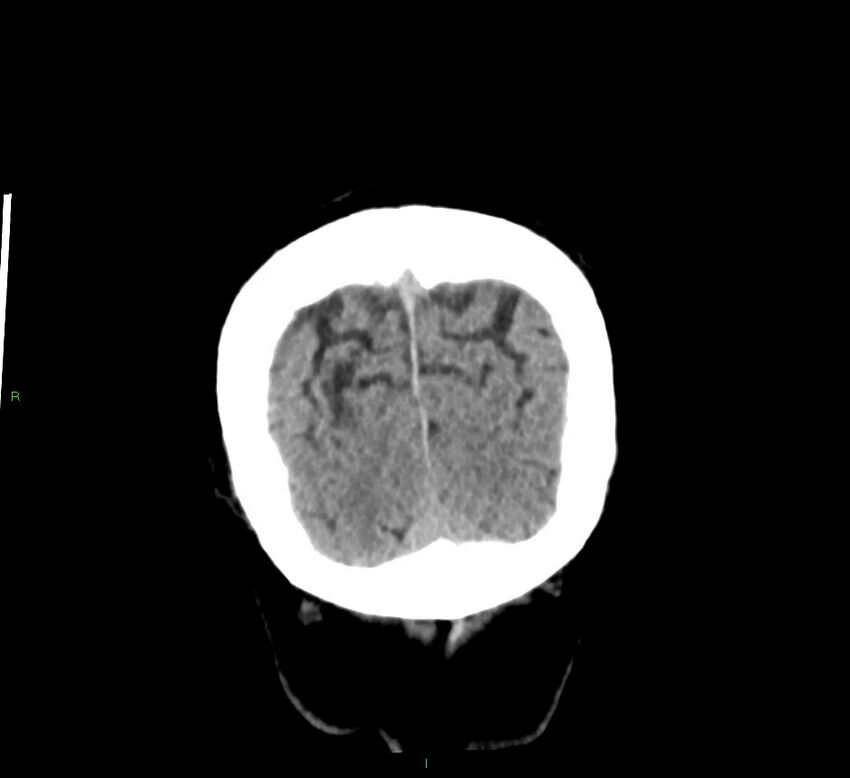 Basal ganglia hemorrhage (Radiopaedia 58791-66025 Coronal non-contrast 8).jpg